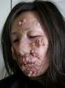 Leprosy%20Stage%205a.jpg