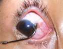 eyeball_piercing_gone_wrong.jpg
