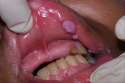 gonorrhea[1].jpg