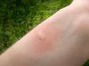 Mosquito-Bites-Itch[1].jpg