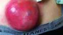 tumor-cyst-2.jpg