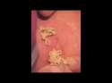 monster-big-zit-close-up-and-pop.jpg