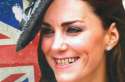 kate_middleton_teeth-300x199.jpg