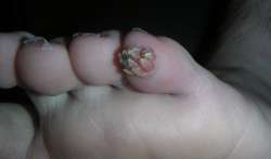 Plantar-Wart-1.jpg