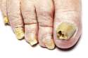 nagelpilz_12956046_ml.jpg