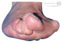 Hallux-valgus-Klinik-schwer.jpg