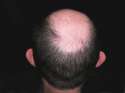 baldhead.jpg