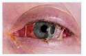tmp_19050-pinkeye-bacteria-844448413.jpg