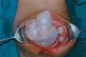 echinococcocis.jpg