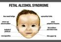 282e09f4780c0a2f736ef11e895b-should-mothers-be-held-criminally-responsible-for-their-children-having-fetal-alcohol-syndrome.jpg
