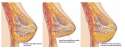 Fat Grafted Tuberous Breast.jpg