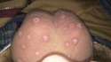 mosquito bites on my balls.jpg
