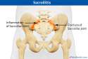 Sacroiliitis.jpg