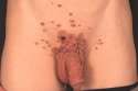 STD_warts.jpg