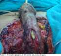 Amputation of the figure1.jpg