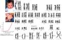 xDOWNS_SYNDROME.jpg.pagespeed.ic.P2DfFbmg3o.jpg