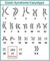 Down_Syndrome_Karyotype.jpg