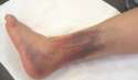 A broke ankle.png