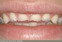 mckay_rm_photo_of_bulima_teeth[1].jpg