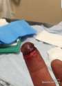 accident-turns-finger-into-penis.jpg