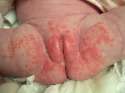 Candidiasis_1_031219.jpg