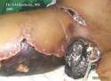 Fournier gangrene_msg3.jpg