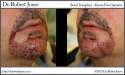 post-op-beard-hair-transplant-933-grafts.jpg