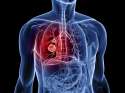 lung-cancer.jpg
