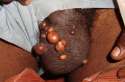 Sebaceous_Cyst_1_110114.jpg