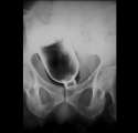 bottle-butt-xray.jpg