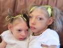 children-born-with-microcephaly.jpg
