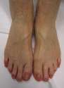 Chilblains_from_excessively_icing_the_feet.jpg
