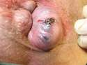 Perianal_thrombosis_01.jpg