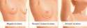 breast-incision-options.png