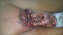 man-penile-myiasis-examine-doctor-india.jpg