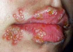 oral-herpes.jpg
