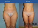 liposuction-before-after.jpg