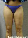 thigh-liposculpture-liposuction-before-fullsize-8534-13996.jpg