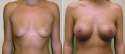 thumbs_breast-enlargement-11-a-paredes-lightershadows.jpg