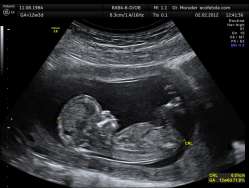 CRL_Crown_rump_lengh_12_weeks_ecografia_Dr._Wolfgang_Moroder.jpg