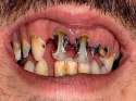 320x240-britains-worst-teeth.jpg