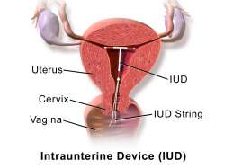 Blausen_0585_IUD.png