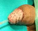 lichen sclerosus.jpg