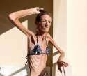 Valeria-Levitina-anorexia-8.jpg