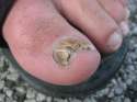 1280px-Fungus_Toenail_0086.jpg