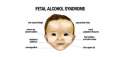 Fetal-Alcohol-Syndrome.jpg