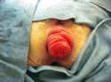 prolapse.jpg