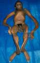 M2300345-Brittle_bone_disease-SPL.jpg