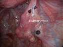 Endometriosis.jpg