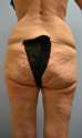 cellulite1.jpg
